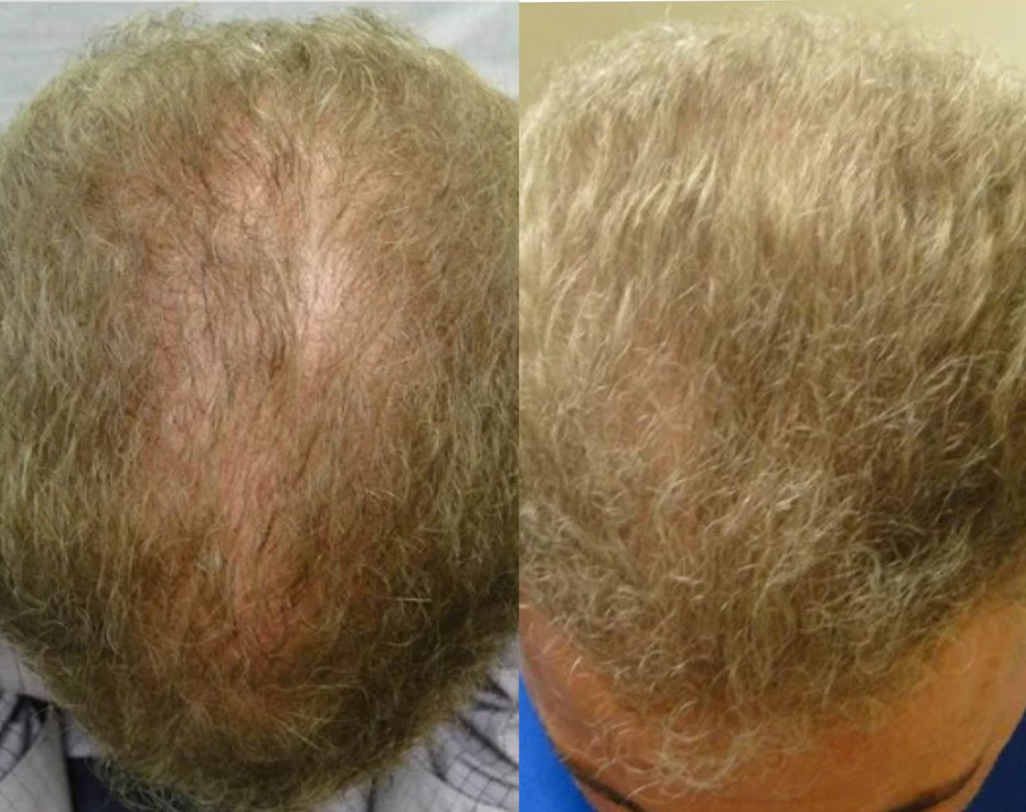 Lustrao Hair regrowth oil